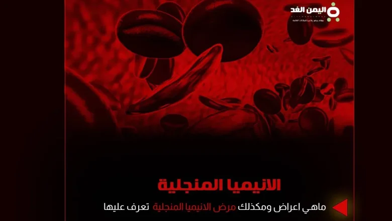 الانيميا المنجلية فقر الدم المنجلي ماهو اسباب اعراض علاج مضاعفات anemia | alyemenalghad.news