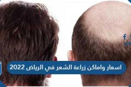 اسعار واماكن زراعة الشعر في الرياض 2022