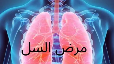 مرض السل(Tuberculosis)؛ أعراضه وأسبابه - شبكة فهرس