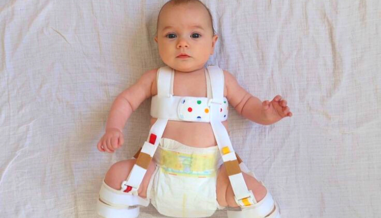 تشوهات مفصل الفخذ