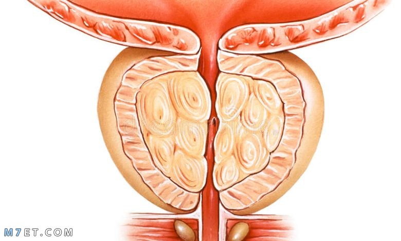  تجربتي مع احتقان البروستاتا