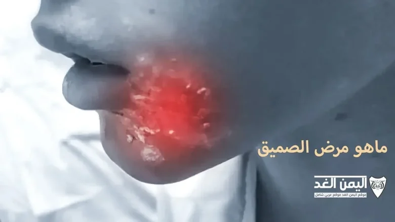 ماهو مرض الصميق وماهي أسباب مرض ابو الصميق وأعراضه وعلاجه ماهو مرض الصميق وماهي أسباب مرض الصميق وأعراضه وعلاجه