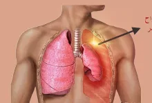 ماهو إسترواح الصدر الأعراض الأسباب وطرق العلاج Pneumothorax