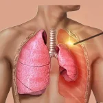ماهو إسترواح الصدر الأعراض الأسباب وطرق العلاج Pneumothorax