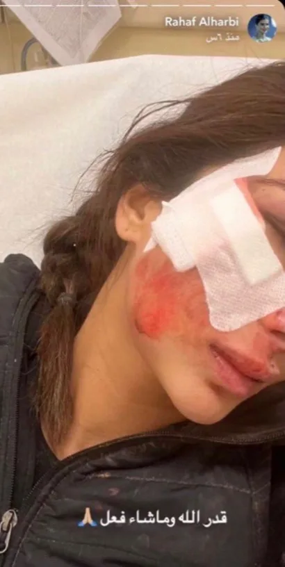 الإصابات اللي تعرضت لها رهف الحربي 