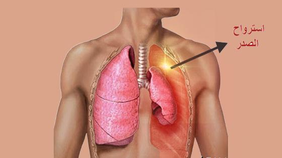 ماهو إسترواح الصدر الأعراض الأسباب وطرق العلاج Pneumothorax